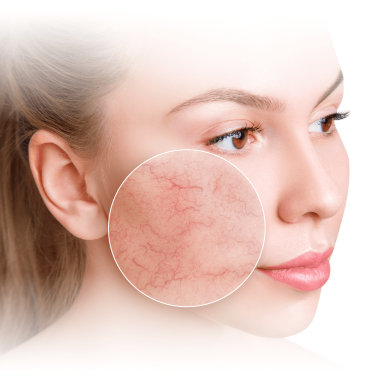 Borminosegjavito_arckezeles_erzekeny_bor_rosacea_acne_borpir_couperosa_nyugtatas_Palatinus_Kozmetika_Kecskemet-2-02